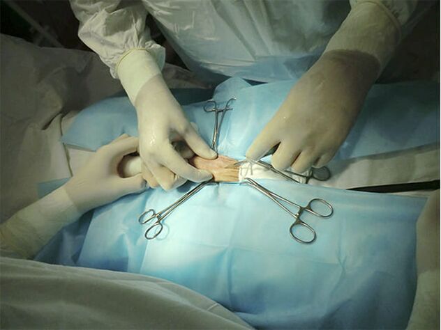 Χειρουργική διεύρυνσης πέους